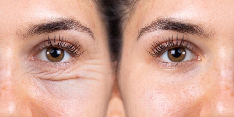 Blefaroplastia — Dr. Mateus Pellizzaro Concórdia SC